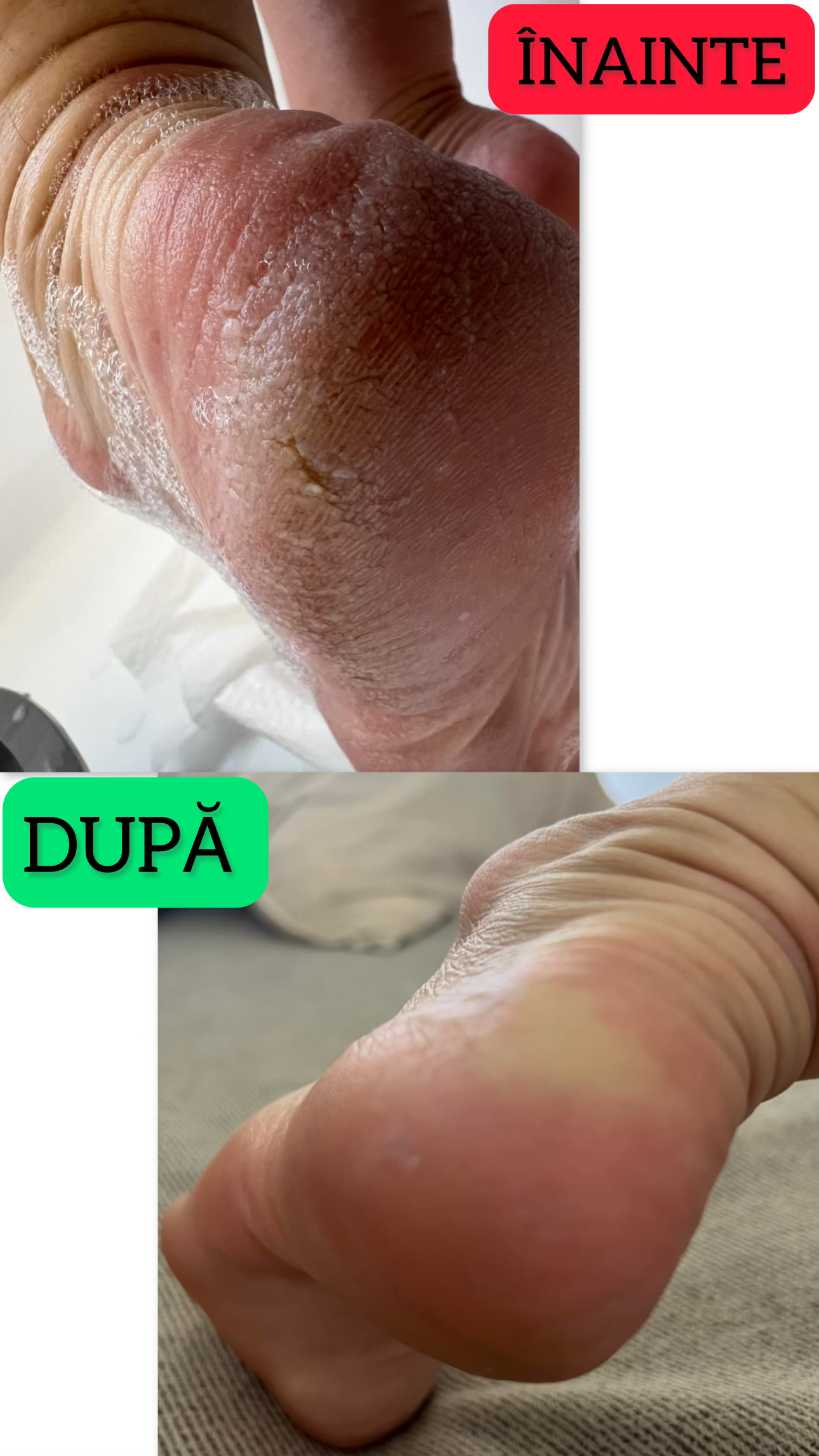 Spray Exfoliant pentru a Îndepărda Pielea Moartă/Crăpată