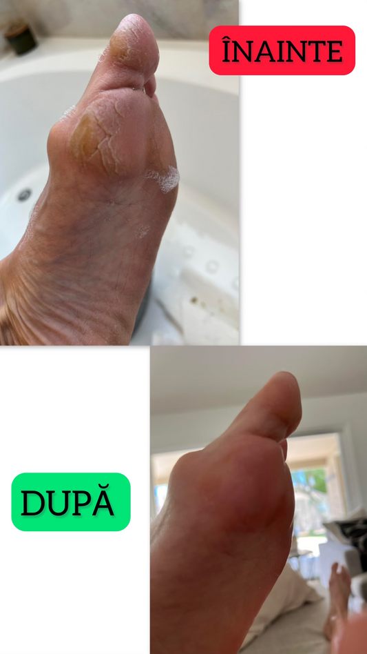 Spray Exfoliant pentru a Îndepărda Pielea Moartă/Crăpată